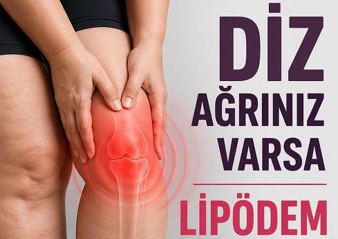 Diz Ağrınız Varsa LİPÖDEM Olabilirsiniz